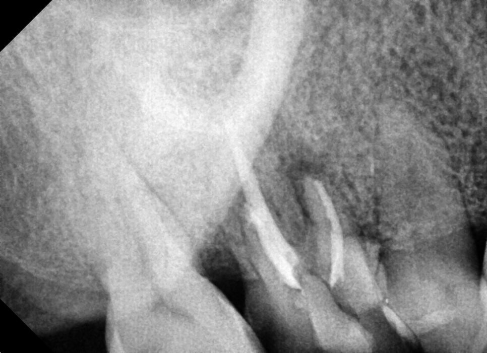 약수역치과, 뿌리염증 치아 신경치료하기( 금 간 치아) 관련 이미지 5