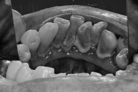 청구역 치과 치주염으로 다수의 치아가 흔들리는 경우(발치, 임플란트) 관련 이미지 3
