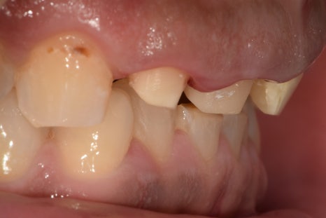 약수동 치과, 삐뚤어진 앞니가 충치가 생겨 치료 후 보철로 가지런한 치아 만들기 관련 이미지 3