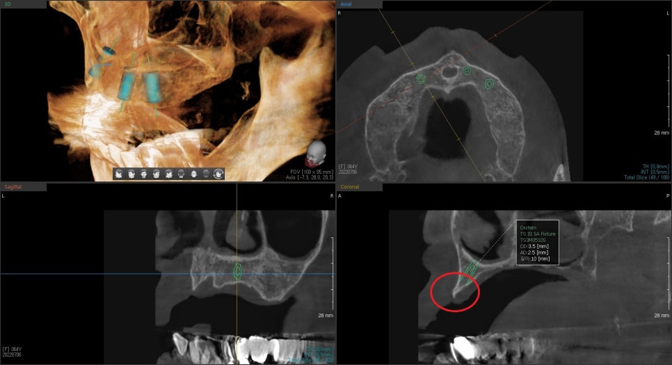 약수동 치과, 전체틀니 오래 쓰신분들 전체 임플란트 가능한가요??(치조골의 흡수양상과 모양) 관련 이미지 4