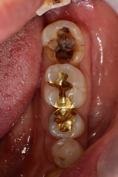 장충동 치과, MTA를 이용한 신경치료 시 주의할 점( 크랙치아, 깊은 충치) 관련 이미지 6
