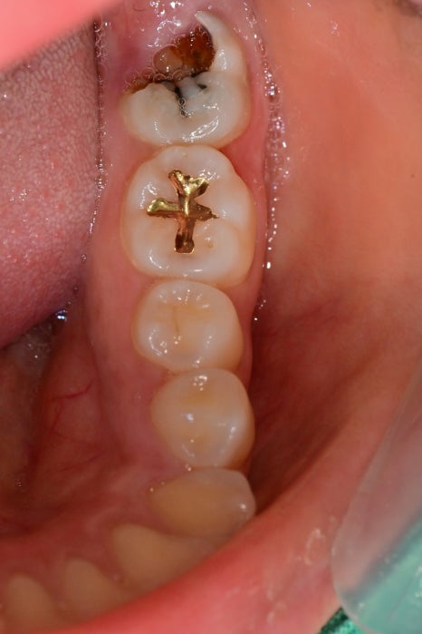 청구역 치과, 충치가 생긴 치아를 초기에 치료를 미루면 안되는 이유!! ( 신경염증, 뿌리주변 염증, 보철치료를 위한 사랑니 발치) 관련 이미지 2