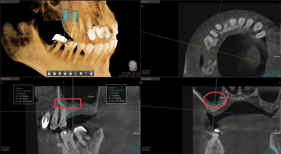 신당역 임플란트 풍치, 심한 치주염인 경우 치과에서 치료 순서 관련 이미지 3