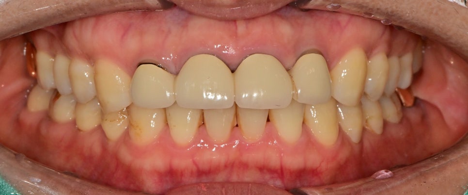 금호역치과 비율이 안 맞는 앞니 재보철치료 관련 이미지 1