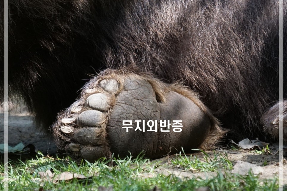 무지외반증 왜생길까? 관련 이미지 1