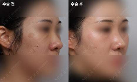 Bulbous Nose Surgery: Is Raising Only the Nose Tip Enough? | Correction Checklist by Cause of Bulbous Nose image 12