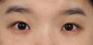 Do You Really Need Epicanthoplasty? Essential Checklist Before Your First Eye Surgery | Epicanthoplasty Side Effects·Cost image 4