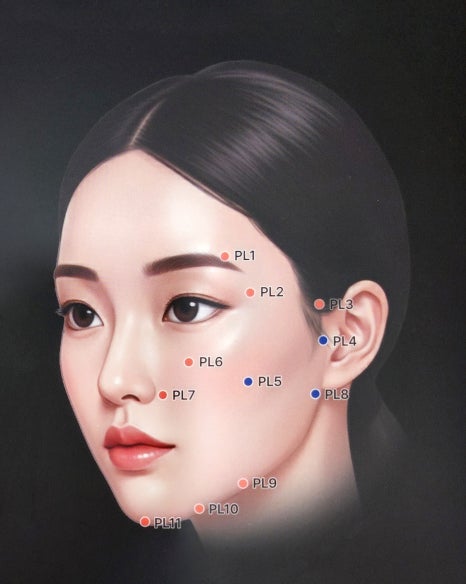 필러로 리프팅이 될까? 레스틸렌 지플랜 필러리프팅 총정리 관련 이미지 8