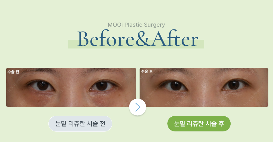 Non-Surgical Under-Eye Rejuvenation: A Complete Guide to Procedures and Effects image 2