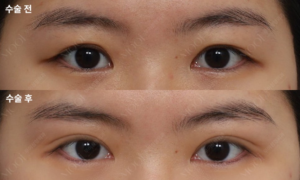Double Eyelid Revision Surgery Cost: The Real Reason It’s More Expensive Than the First Surgery | What You Must Know Before Eye Revision Surgery image 6