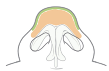 Bulbous Nose Surgery: Is Raising Only the Nose Tip Enough? | Correction Checklist by Cause of Bulbous Nose image 8