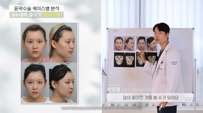 윤곽 2종 3종 차이, 얼굴 여백 줄이기 총정리 관련 이미지 8