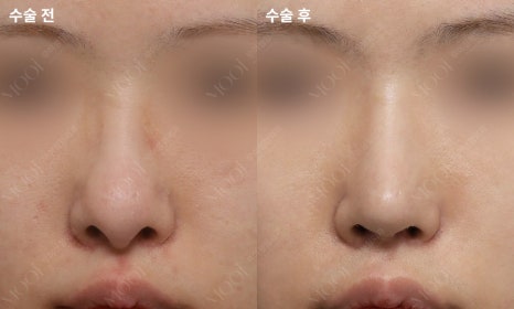 코재수술 늑연골: 자가늑/기증늑(동종늑연골) 어떤 경우에 선택할까 관련 이미지 13