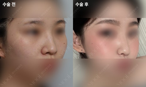 Bulbous Nose Surgery: Is Raising Only the Nose Tip Enough? | Correction Checklist by Cause of Bulbous Nose image 5