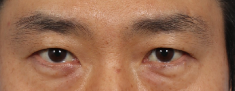 Drooping Eyelid Surgery: A Complete Guide to 3 Methods image 6