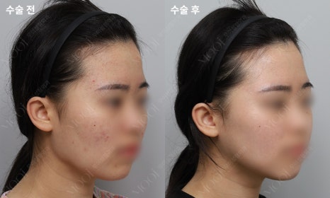 안면윤곽수술 후 회복, 처음 2주가 결과를 만들어요 (뼈수술 관리법 총정리) 관련 이미지 7