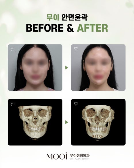 CRMO Patient Underwent Jawline Reduction Surgery — What Were the Results? Real Surgery Process Revealed, Part 2 image 6