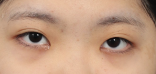 Do You Really Need Epicanthoplasty? Essential Checklist Before Your First Eye Surgery | Epicanthoplasty Side Effects·Cost image 5