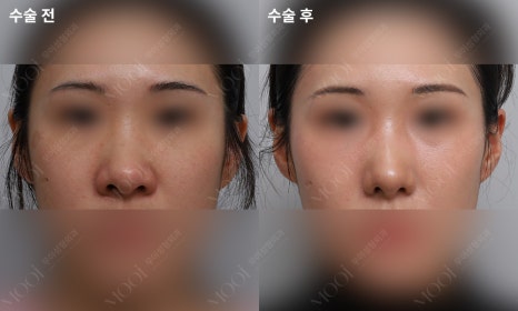 Bulbous Nose Surgery: Is Raising Only the Nose Tip Enough? | Correction Checklist by Cause of Bulbous Nose image 11
