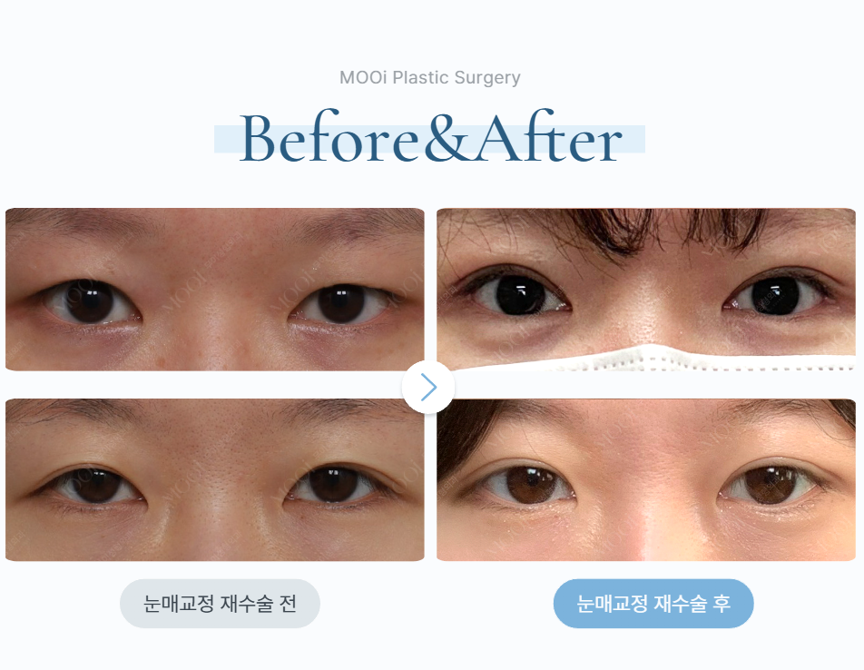 If a Double Eyelid Fold Comes Loose, Do You Need to Repeat Ptosis Correction Too? image 2