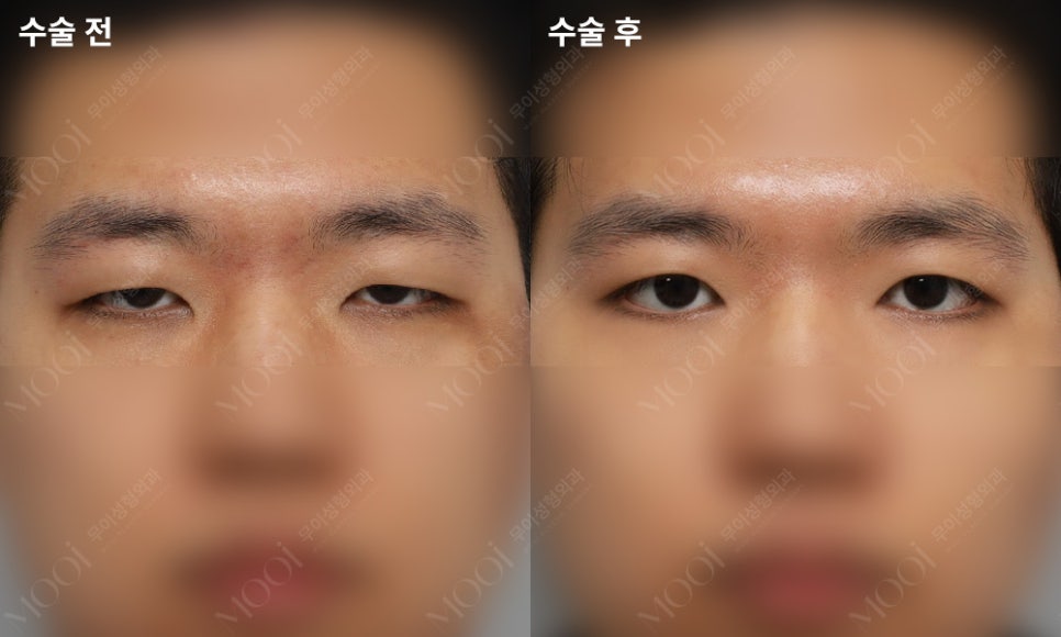 Three Things You Must Know Before Male Epicanthoplasty and Canthoplasty image 4