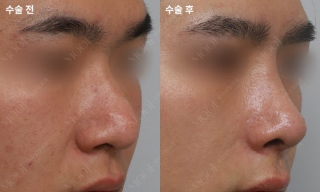 코재수술 늑연골: 자가늑/기증늑(동종늑연골) 어떤 경우에 선택할까 관련 이미지 3