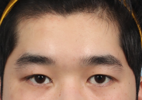 Drooping Eyelid Surgery: A Complete Guide to 3 Methods image 5