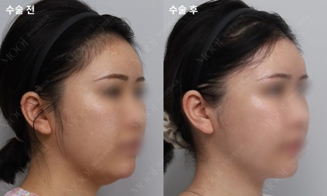 안면윤곽수술 후 회복, 처음 2주가 결과를 만들어요 (뼈수술 관리법 총정리) 관련 이미지 4
