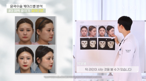 윤곽 2종 3종 차이, 얼굴 여백 줄이기 총정리 관련 이미지 5