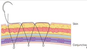 Natural Adhesion vs. Incisional Double Eyelid Surgery: Which One Is Right for Me? | Complete Guide to the Differences Between Non-Incisional Double Eyelid Surgery image 2