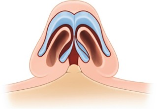 Bulbous Nose Surgery: Is Raising Only the Nose Tip Enough? | Correction Checklist by Cause of Bulbous Nose image 3
