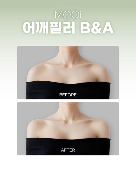 Everything About Body Fillers: How to Define Your Contours from Shoulder Fillers to Hip Fillers image 3