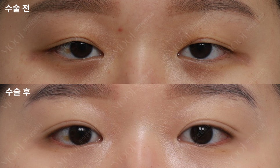 Double Eyelid Revision Surgery Cost: The Real Reason It’s More Expensive Than the First Surgery | What You Must Know Before Eye Revision Surgery image 7