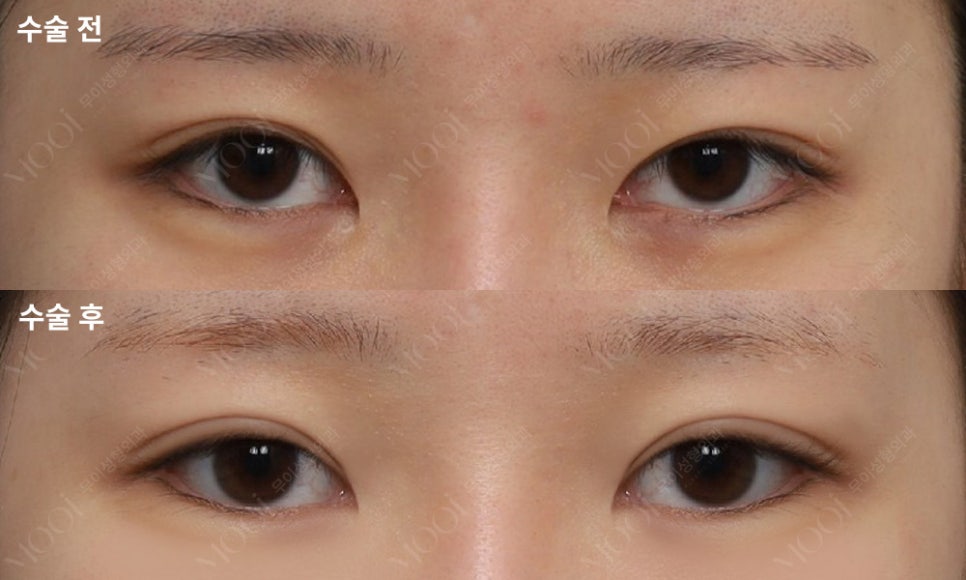 쌍꺼풀 재수술, 하기 전 꼭 확인할 체크 리스트 총정리 관련 이미지 3