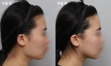 안면윤곽수술 후 회복, 처음 2주가 결과를 만들어요 (뼈수술 관리법 총정리) 관련 이미지 5