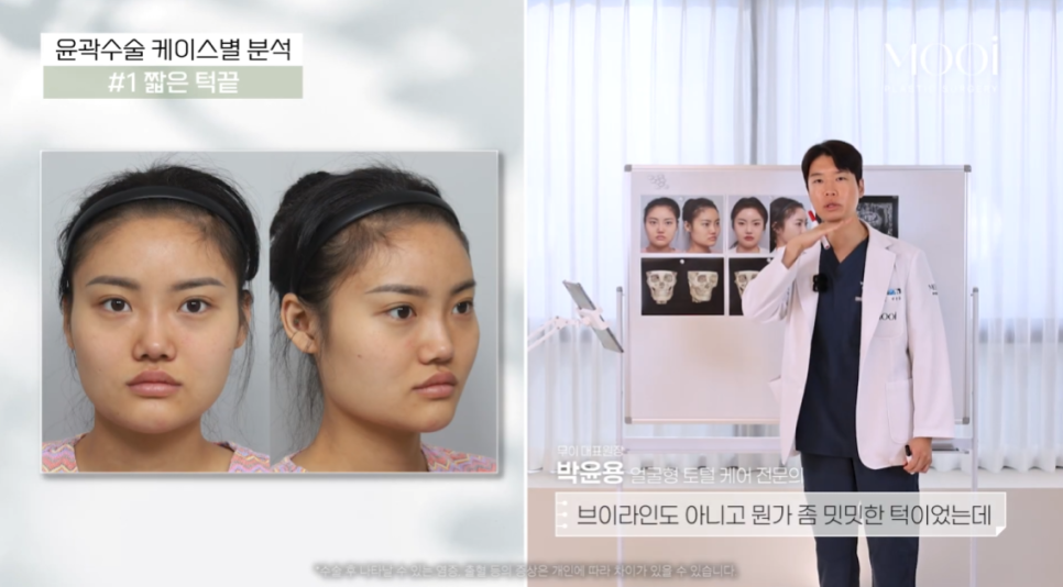 무턱, 이중턱 짧은 턱끝, 턱끝성형으로 V라인 만드는 법 관련 이미지 2