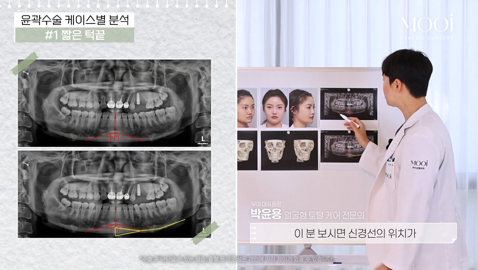 무턱, 이중턱 짧은 턱끝, 턱끝성형으로 V라인 만드는 법 관련 이미지 3