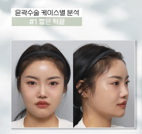 무턱, 이중턱 짧은 턱끝, 턱끝성형으로 V라인 만드는 법 관련 이미지 6