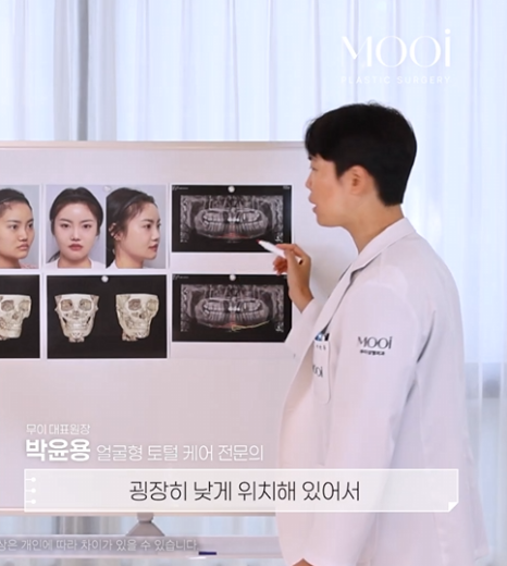무턱, 이중턱 짧은 턱끝, 턱끝성형으로 V라인 만드는 법 관련 이미지 4