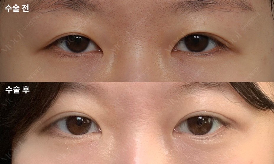 짝짝이눈 교정, 원인부터 수술 방법까지 총정리 | 쌍꺼풀 비대칭&middot;눈 비대칭 교정 관련 이미지 3