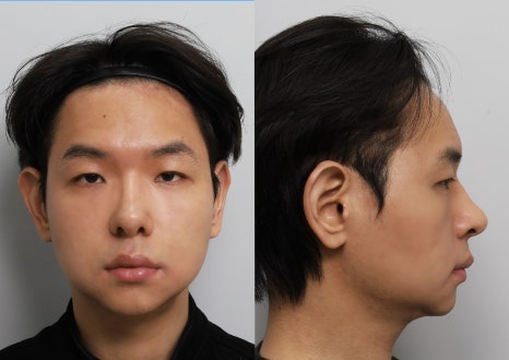 무턱, 턱끝 전진만으로 입체감이 생길까? 턱끝수술 실제 케이스 분석 관련 이미지 3