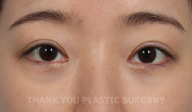 Double Eyelid Revision Surgery Cost: The Real Reason It’s More Expensive Than the First Surgery | What You Must Know Before Eye Revision Surgery image 4