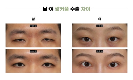 남자 쌍꺼풀 수술, 여자와 뭐가 다를까? (차이점 총정리) 관련 이미지 2