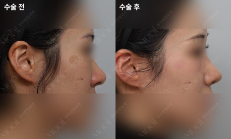 Bulbous Nose Surgery: Is Raising Only the Nose Tip Enough? | Correction Checklist by Cause of Bulbous Nose image 13