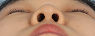 Bulbous Nose Surgery: Is Raising Only the Nose Tip Enough? | Correction Checklist by Cause of Bulbous Nose image 9