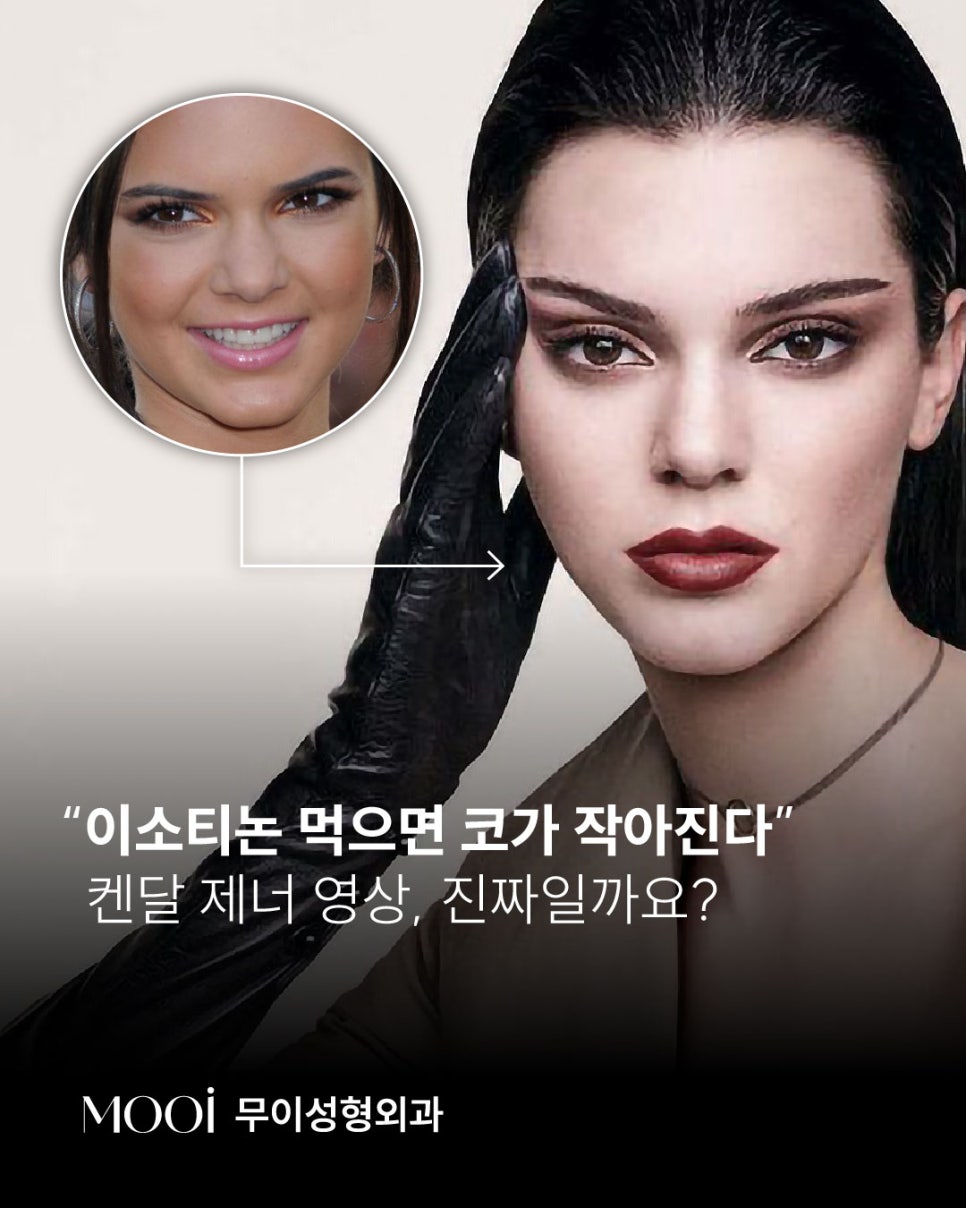 The Truth About Kendall Jenner Videos and the Isotretinoin Nose-Reduction Effect image 1