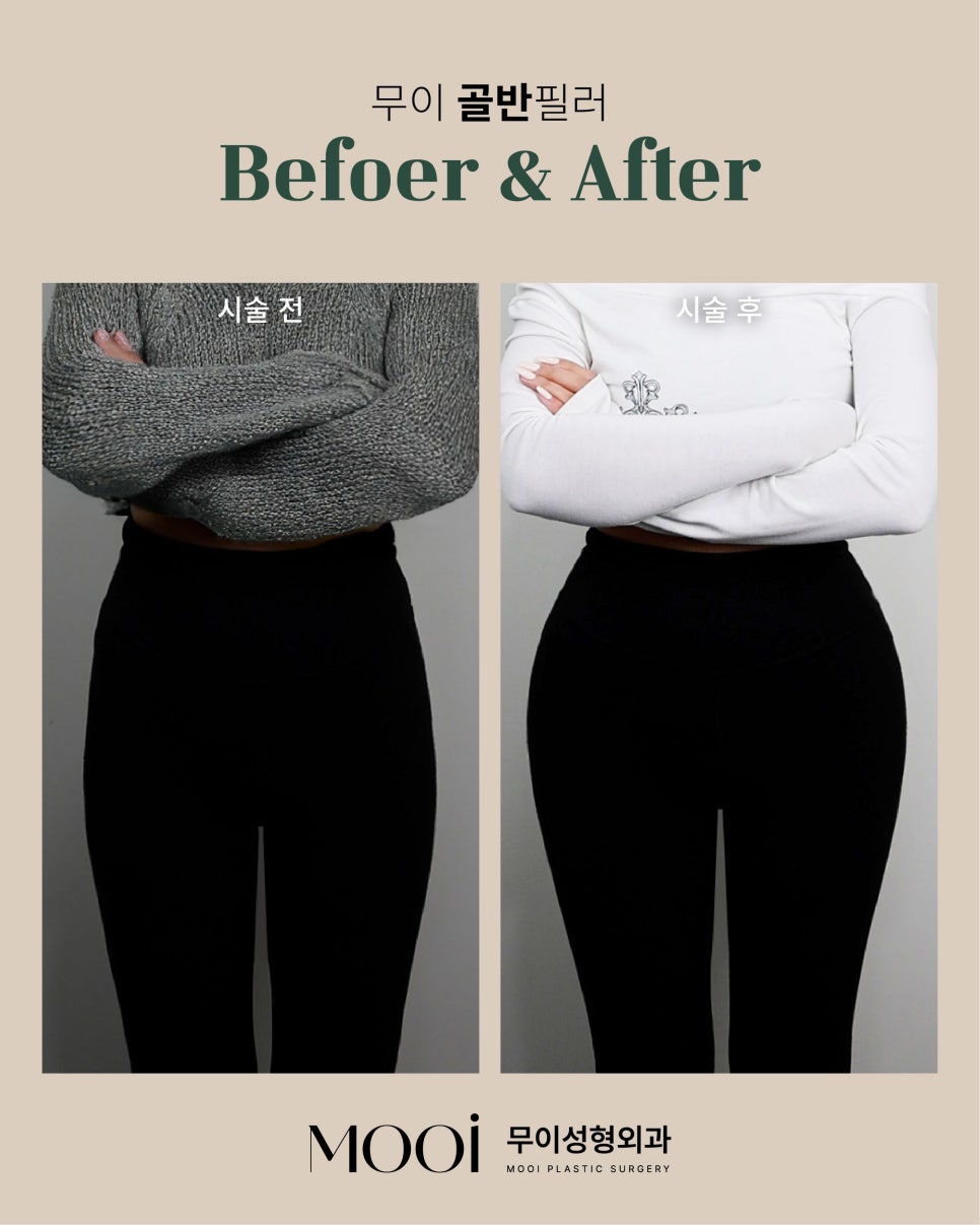 Why Pelvic Fillers and Shoulder Fillers Are About Line Design, Not Just Volume image 3