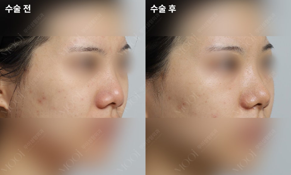 A Complete Summary of the Differences Between Nosing and Nose Filler | Everything About Non-Incisional Rhinoplasty with Lifting Threads image 2