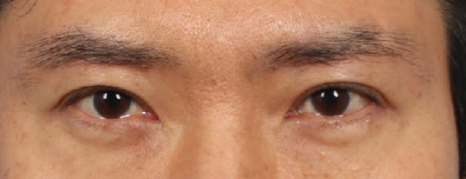 Drooping Eyelid Surgery: A Complete Guide to 3 Methods image 7