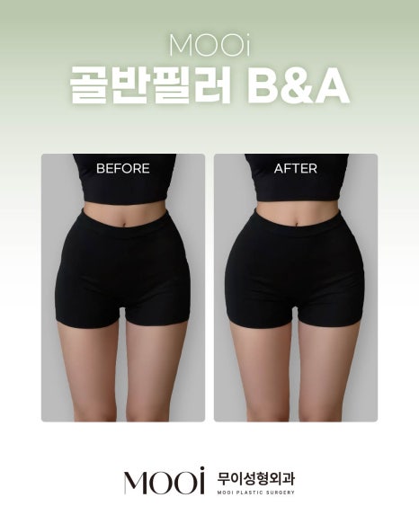 Everything About Body Fillers: How to Define Your Contours from Shoulder Fillers to Hip Fillers image 5